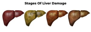 Stages of liver damage